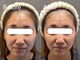 ヘレフア(Hele Hua)の写真/≪NewOpen≫左右差やエラ張りの悩みも解消!痛みの少ない!"造顔技術"で理想のフェイスラインを◎新琴似/麻生