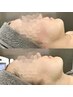 【小顔矯正リフトNo.1】『瞬間リフトアップ』小顔リフト3層+脂肪分解 5000発
