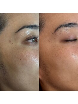 こうぞう整体院/美容鍼×ピーリング