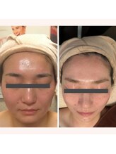 リリー ボヌール(Lily bonheur)/恋のア・モーレリフト美顔