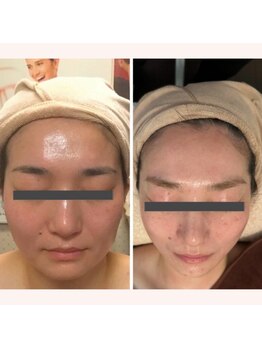 リリー ボヌール(Lily bonheur)/恋のア・モーレリフト美顔