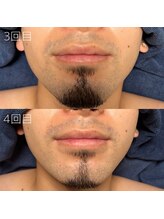 カナウ(KANAU)/ヒゲ脱毛（20代前半男性）
