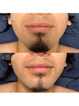 カナウ(KANAU)/ヒゲ脱毛（20代前半男性）