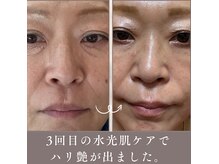 エステリワール|韓国肌管理・韓国育毛促進ケア・小顔・毛穴・脱毛・シワたるみの雰囲気(水光肌3回目!続けるとここまで綺麗になります!)