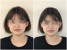 オーレ 秋葉原店(ole)/【小顔矯正】ビフォアアフター