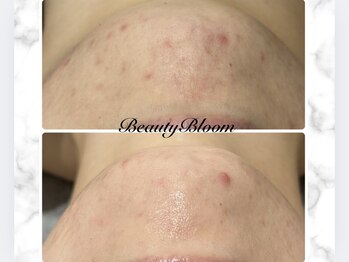 ビューティーブルーム(BeautyBloom)/顎周りも綺麗に★