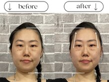 ビースタイル(B-style)/【美容鍼灸】ビフォーアフター