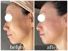 ルー ハナレ 神戸岡本 摂津本山店(Luu HANARE)/くすみ 肌質改善 韓国美肌ケア