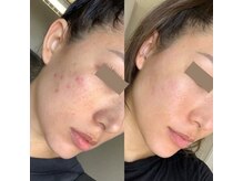 アリーベル 新越谷 南越谷(Allybell)/スノーピーリング