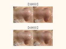 ドリームスパ 武蔵小杉店(DREAM SPA)/毛穴吸引＋引き締めパック＋導入