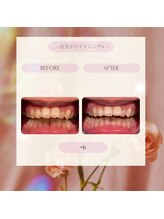 プラスビー 2号店(+b)/ホワイトニングビフォーアフター