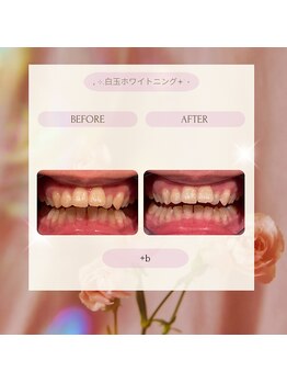 プラスビー 2号店(+b)/ホワイトニングビフォーアフター