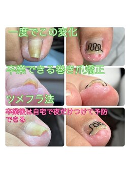 ナチュエイド/ツメフラ法