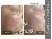 グロウ(glow.)/時間がかかる凹凸肌改善