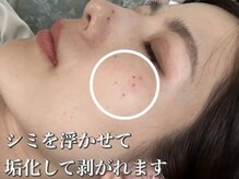 ジュパール(je pars)/低周波シミケア