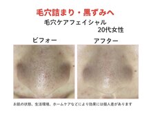 ダーウィン(Darwin)/黒ずみすっきり術