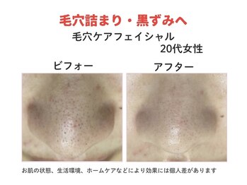 ダーウィン(Darwin)/黒ずみすっきり術