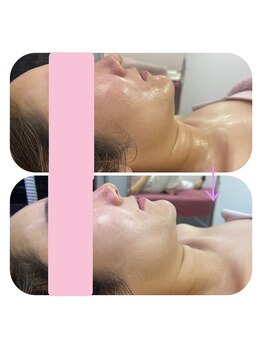 シャイニー(SHINY)/タイムバックコース