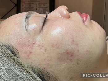 フィール(feel)/After 3ヶ月