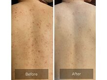 ルナート(Lunart)/ハーブピーリング【背中】