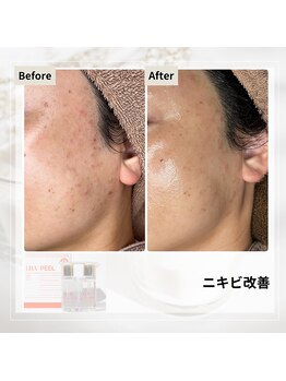 ルアナ(Luana)/ララピールの効果★