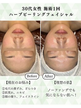 シーフェイス 横浜店(SEE FACE)/毛穴くすみケアハーブピーリング