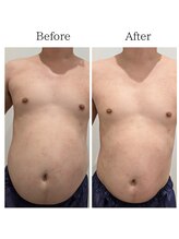 セルノヴァ(Cell Nova)/お腹/痩身/痩身ダイエット