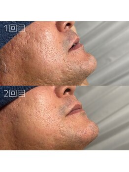 カナウ(KANAU)/ヒゲ脱毛（40代後半男性）
