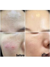 エクスクラメーションマーク(!!!)/ハーブピーリング