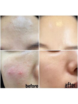 エクスクラメーションマーク(!!!)/ハーブピーリング