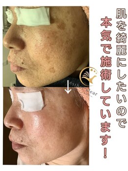 エステルクリア(esther clear)/肌対策は諦めないっ!!