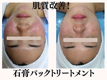 りりあす/肌荒れ、ニキビケア、毛穴汚れ