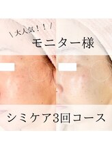 ニコ ウィズ(Nico with)/シミケア◎ビフォーアフター