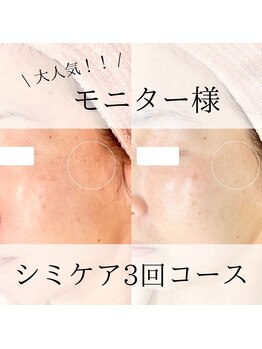 ニコ ウィズ(Nico with)/シミケア◎ビフォーアフター