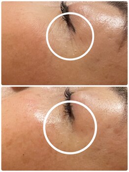 ケイサロン 朝霞店(K salon)/ハーブピーリングbefore・after