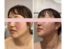 ティアラ(TIARA)/【小顔、たるみ】テラボーラー