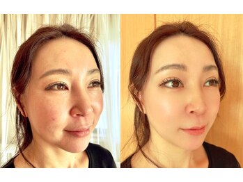 オリノ(Olino)/リジュランエステ１回での効果！