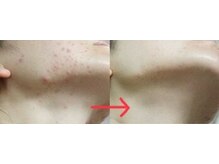 ルナート(Lunart)/ハーブピーリング【顔】