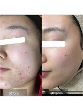 ココ 梅田中津(COCO.)/ニキビケア＊ハーブピーリング