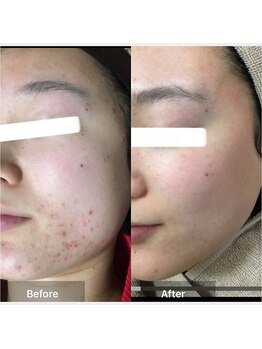 ココ 梅田中津(COCO.)/ニキビケア＊ハーブピーリング