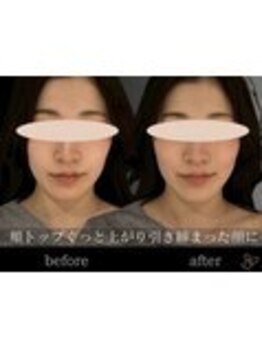 チョコバリ 錦糸町店(chocobari)/小顔×リフトアップ(美容鍼)20代