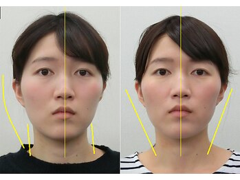 宮崎整体院/【小顔矯正・顔の歪み矯正】