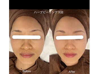 ライフ美容整体院 恵比寿(Life美容整体院)/毛穴ケア