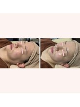 リリー ボヌール(Lily bonheur)/ソニックリフトトリートメント