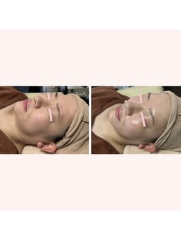 リリー ボヌール(Lily bonheur)/ソニックリフトトリートメント