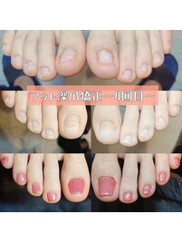 サンダルが履ける足爪へ