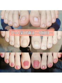 サンダルが履ける足爪へ