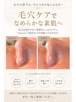 ブリス(BLISS.)の写真/毛穴メニューとシェービングで効果が最大に！毛穴悩みを根本改善◎