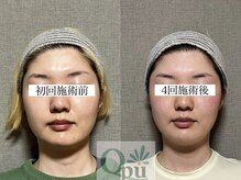 キュープ 表参道店(Qpu)の雰囲気（継続の積み重ねが戻りにくい小顔をつくります。【小顔矯正】）