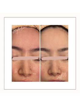 シェービングアンドエステ ブランピュア(Blanc pur)/毛穴引き締め、赤みの鎮静効果!